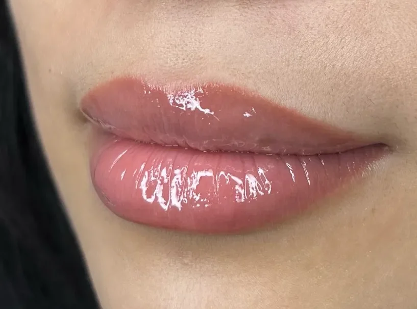Lip Neutralisation Melbourne