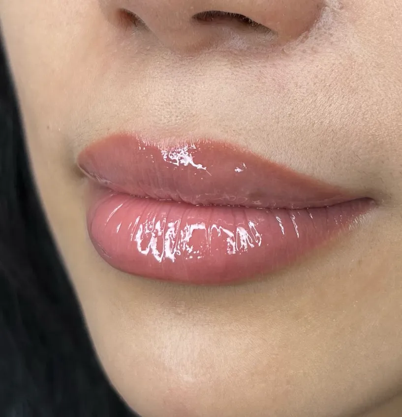Lip Neutralisation Melbourne