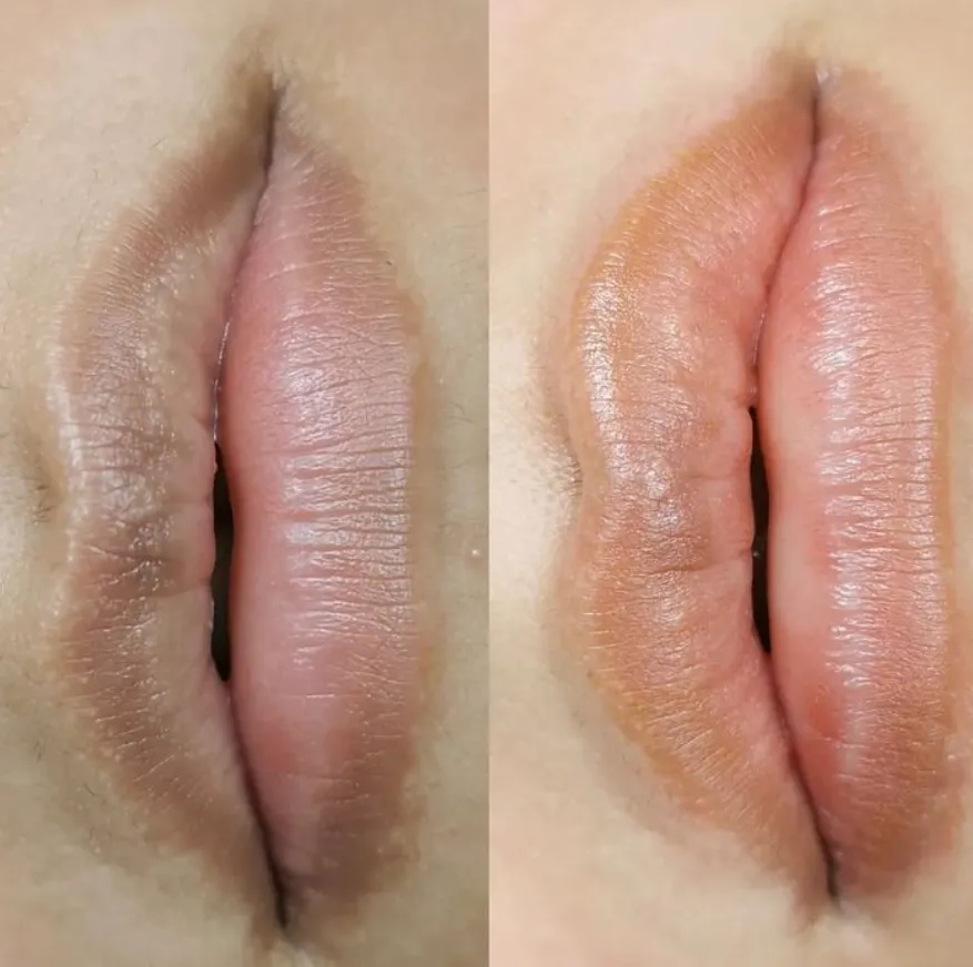 dark lip neutralization