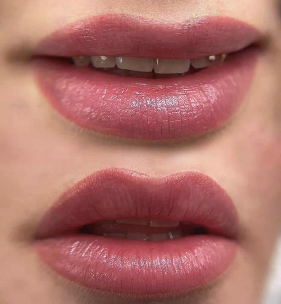 lip neutralization before and after