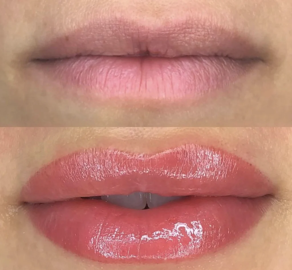 lip neutralization melbourne