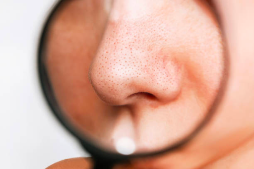 Effective Facial Treatment for Blackheads & Large Pores